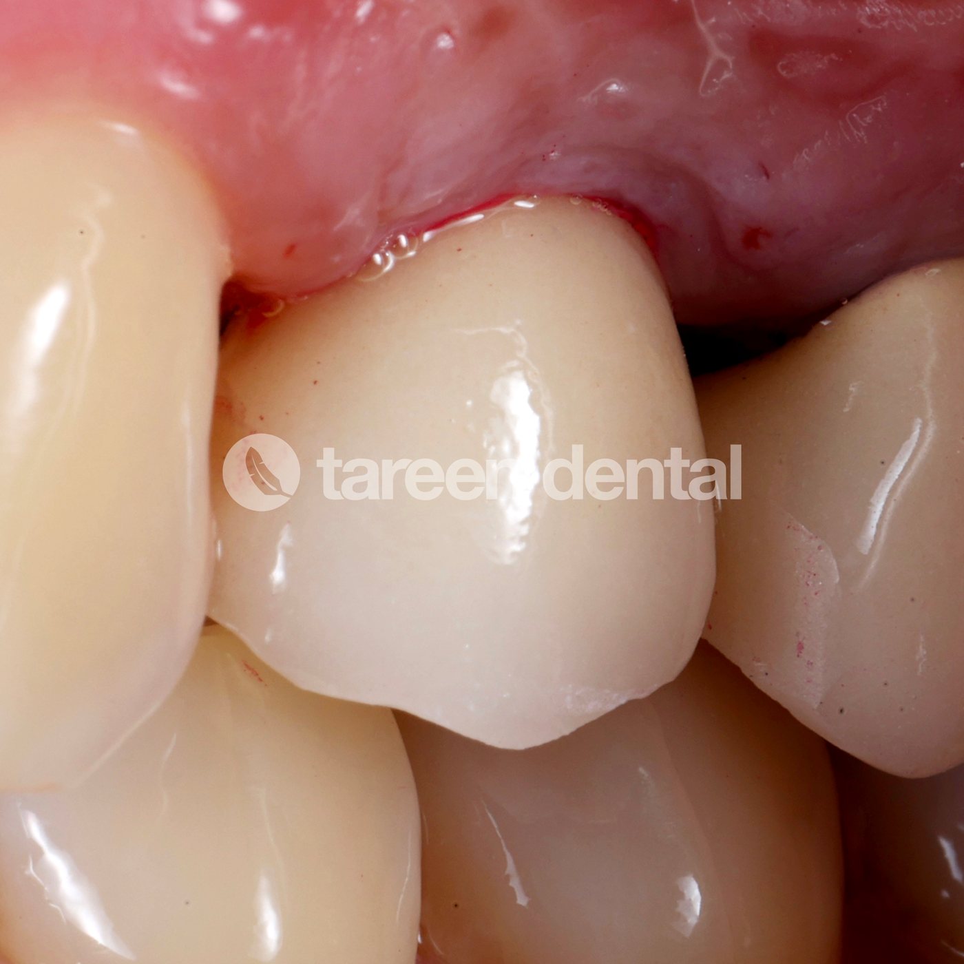Implant crown insertion