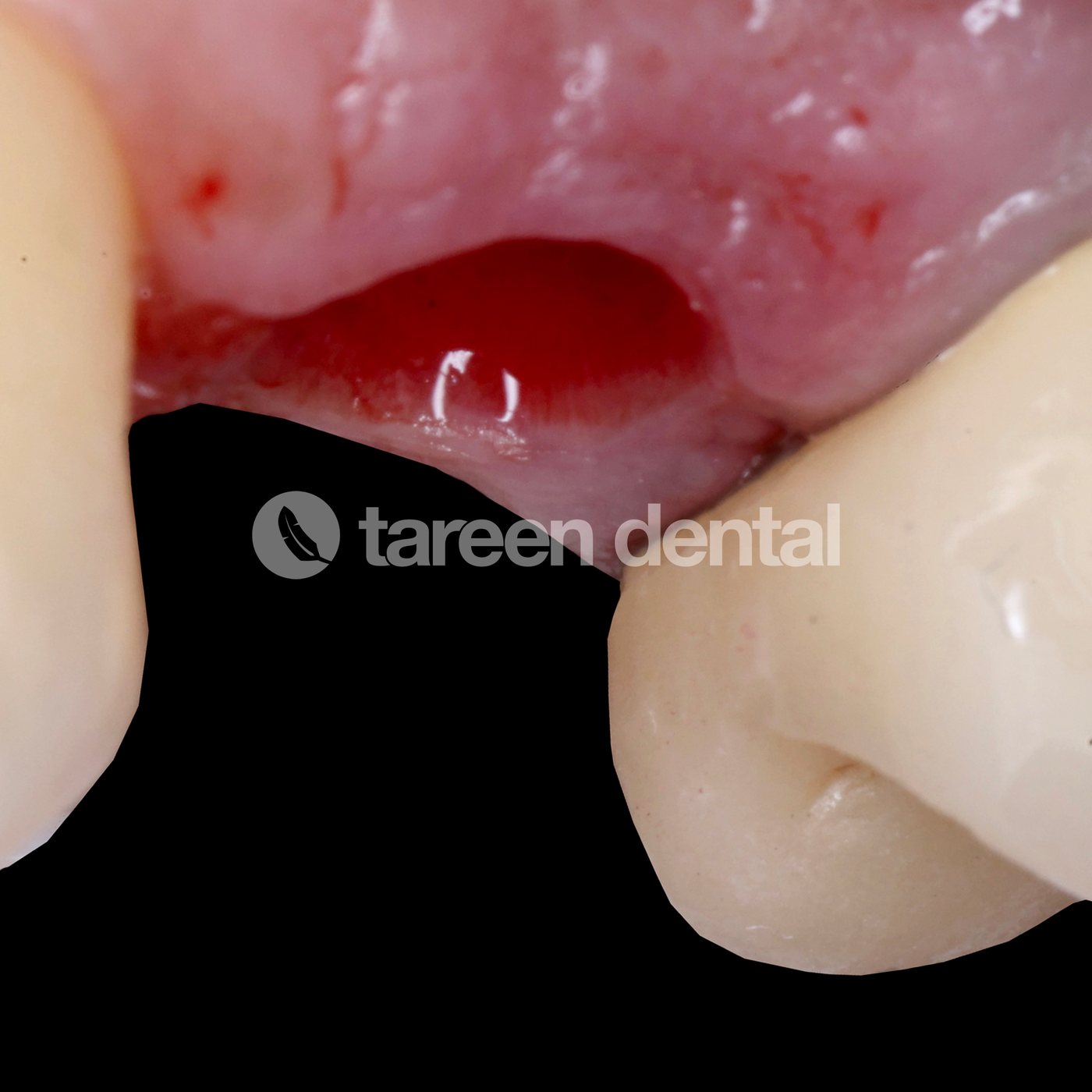 Implant site