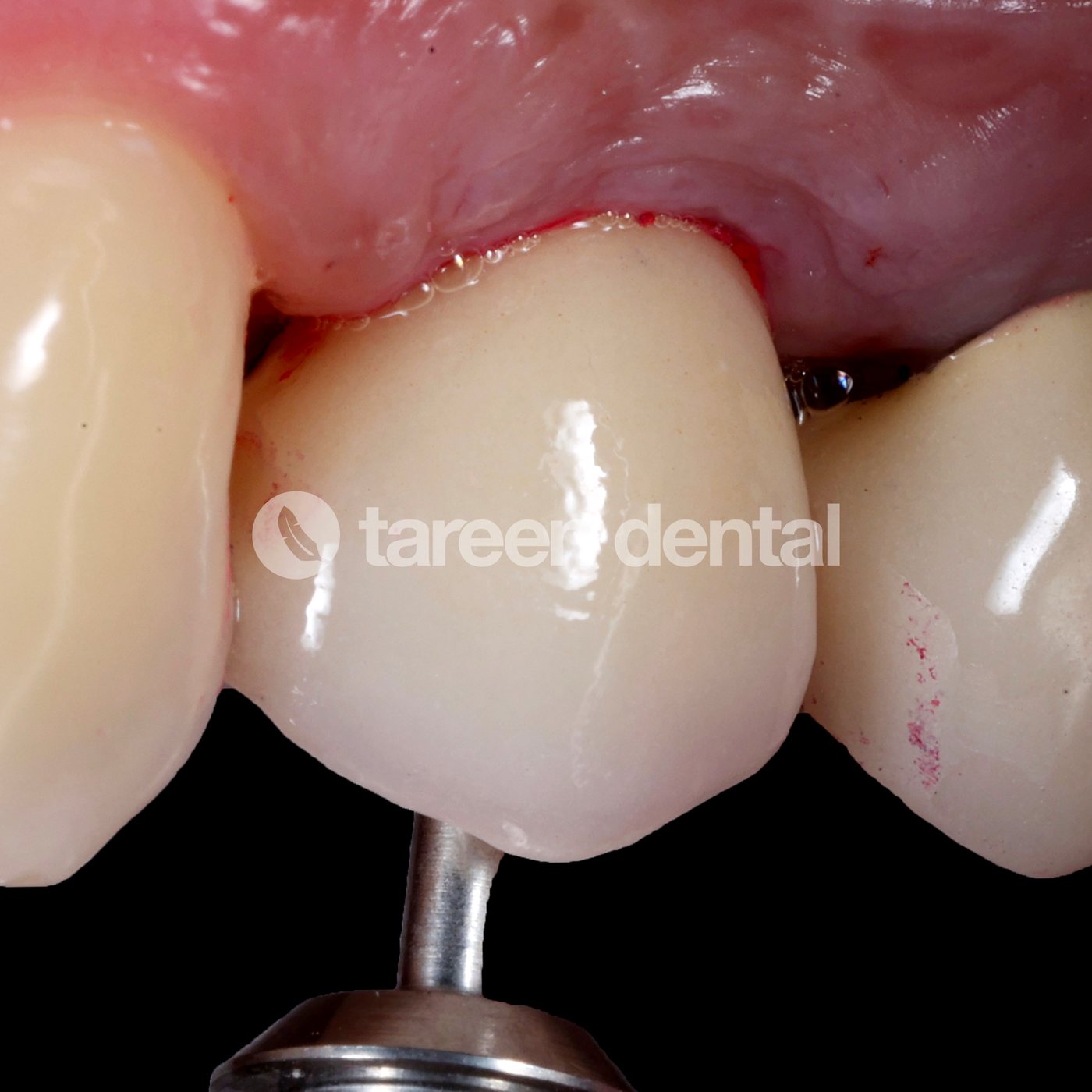 Anterior implant crown try-in