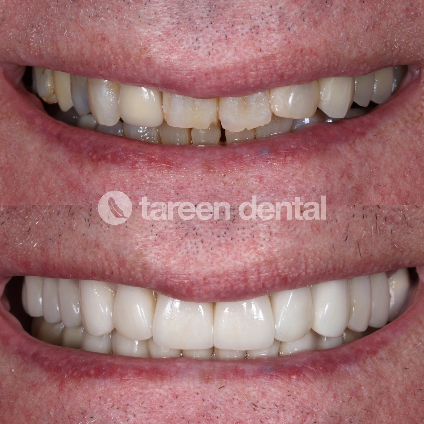 Before and after porcelain restorations