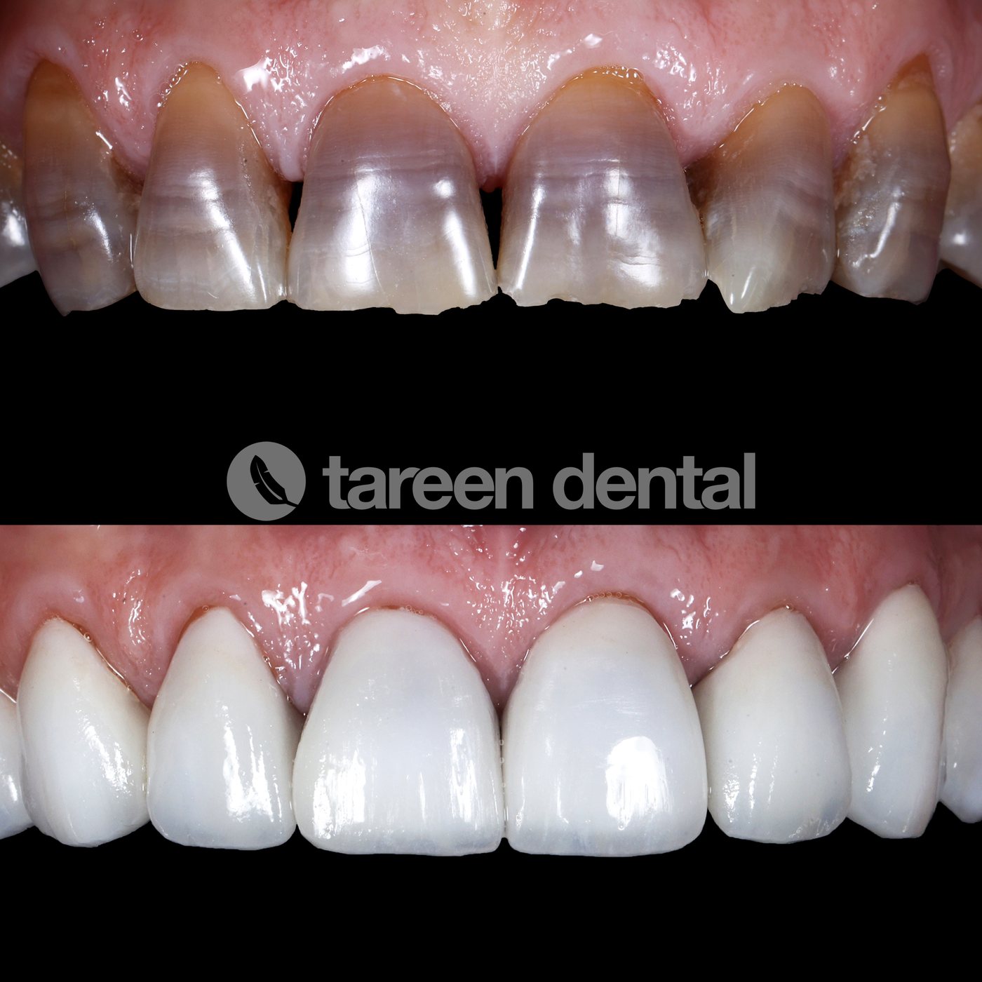 Full smile rehabilitation with porcelain